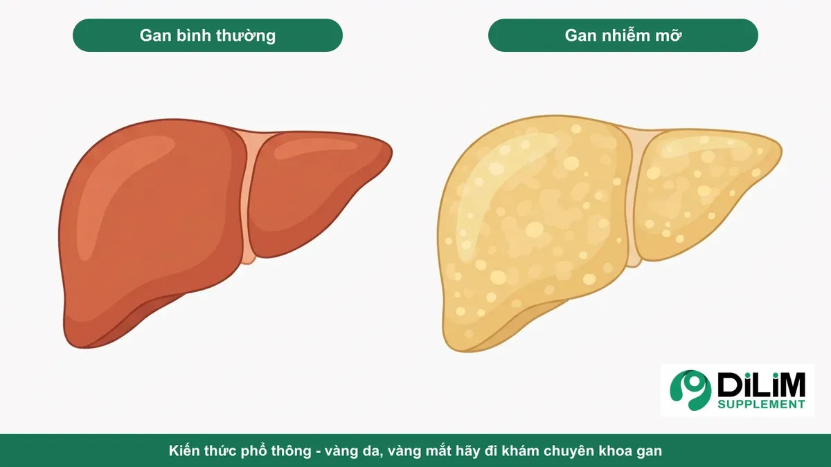 Minh họa kiến thức phổ thông: lá gan bình thường và gan nhiễm mỡ
