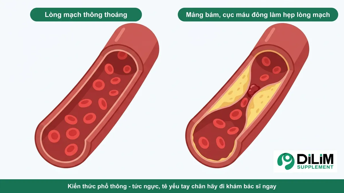 Minh họa kiến thức phổ thông: lòng mạch máu thông thoáng và lòng mạch hẹp do mảng bám, cục máu đông
