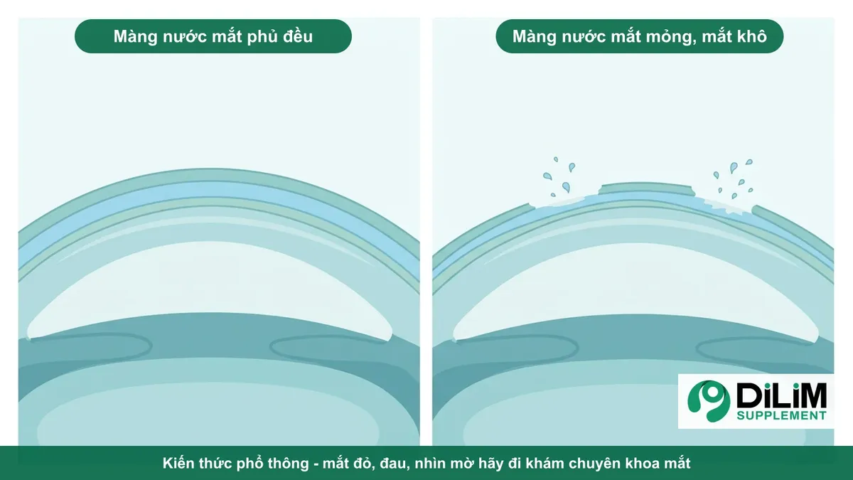 Minh họa kiến thức phổ thông: màng nước mắt phủ đều và màng nước mắt mỏng khi mắt khô
