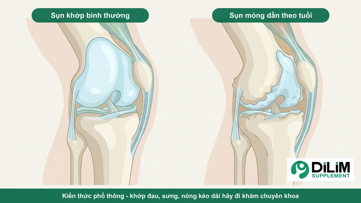 Minh họa kiến thức phổ thông: sụn khớp gối bình thường và sụn mỏng dần theo tuổi